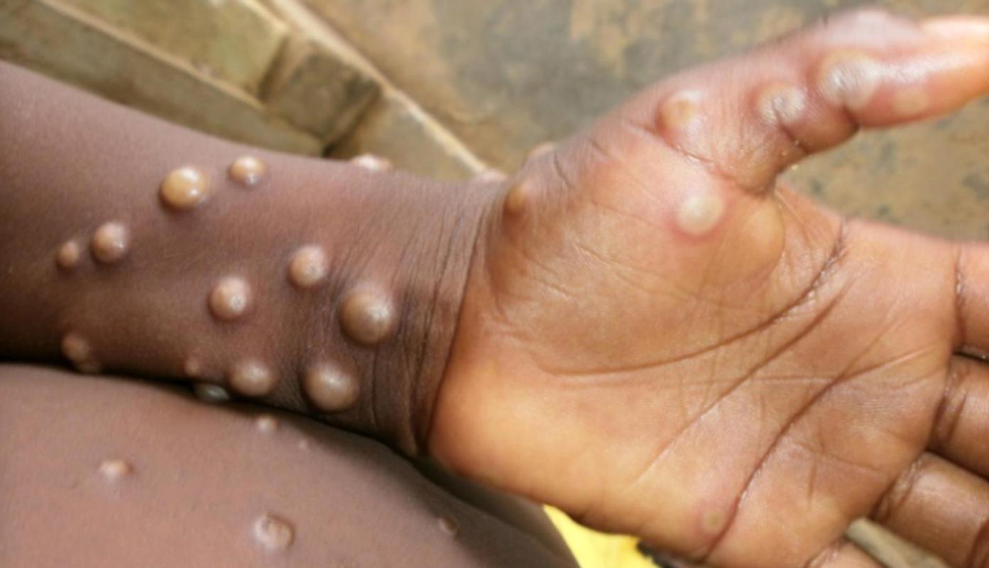 Centers for Disease Control and Prevention
